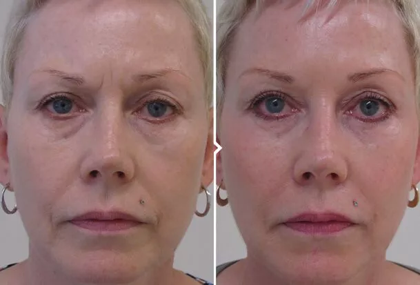 Non Surgical Facelift Glasgow
